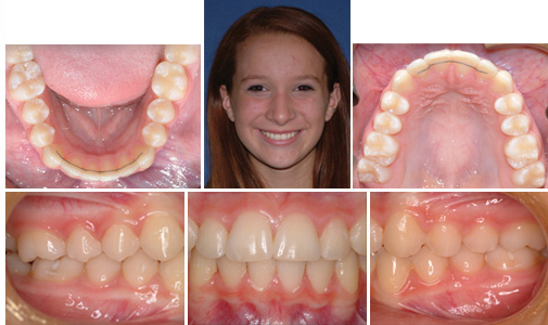 before and after
