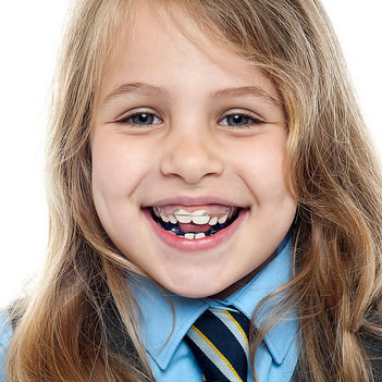 early orthodontic treatment